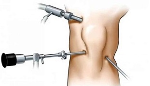 uređaj za liječenje ultrazvučne artroze bol u ramenu joint, rame