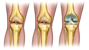 Artroza koljena: uzroci, glavni simptomi i metode liječenja