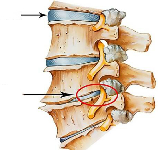vježba za liječenje artroze koljena zajednički bol je teško disati