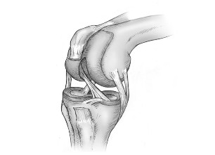 Osteoartritisa koljena: tretman i simptomi