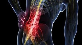 liječenje artroze i bursitisa ramenog zgloba)