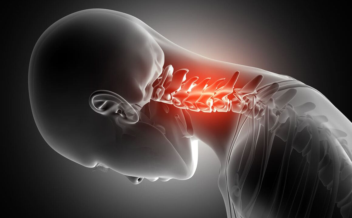 Osteohondroza vratne kičme