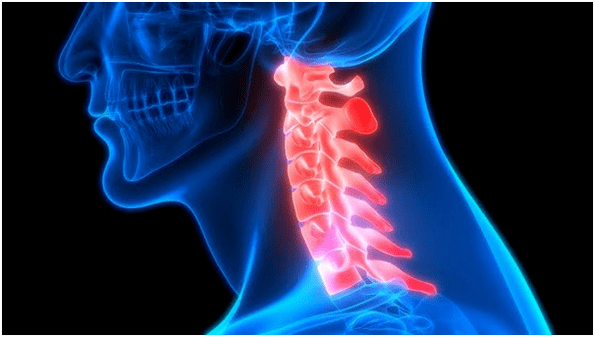 bol u vratu dovodi do bolova u leđima