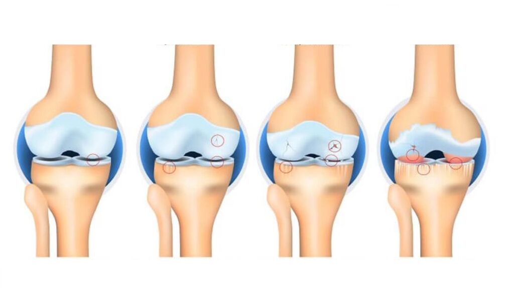 stadijuma artroze kolenskog zgloba