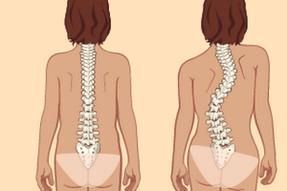 uspravno držanje i skolioza s torakalnom osteohondrozo