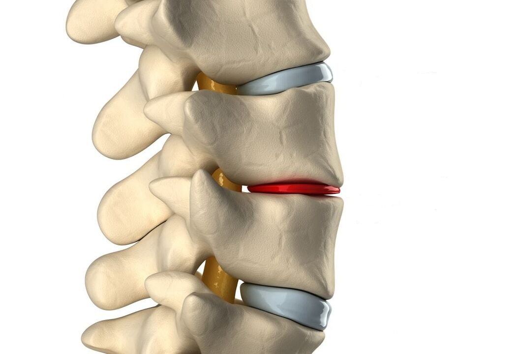 Zdrav intervertebralni disk (plavi) i oštećen zbog torakalne osteohondroze (crveni)