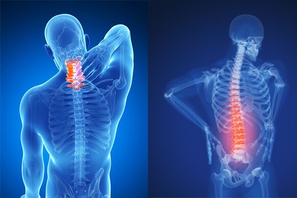 Osteohondroza vratne i lumbalne kičme