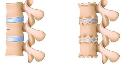 Kako prepoznati prisustvo osteohondroze lumbalnog