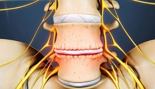 glavni simptomi cervikalne osteohondroze
